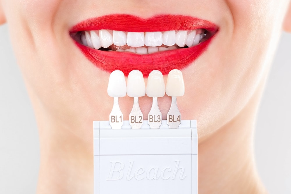 How to Take Care of Porcelain Veneers?