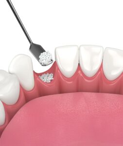 Bone Grafting Anchorage - Alaska Dentist Services – Bone Graft Tooth Procedure