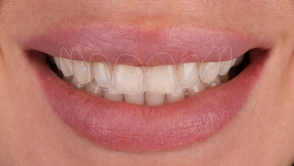 Treatments for a Smile Makeover