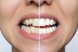 Improving Smile with Dental Veneers in Anchorage