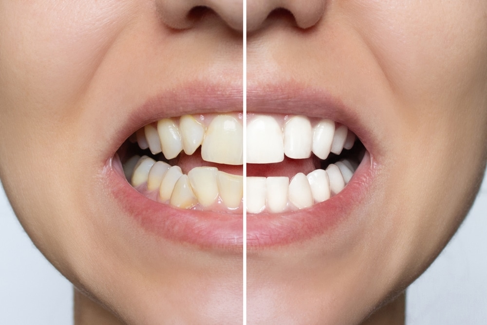 Improving Smile with Dental Veneers in Anchorage