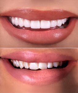 veneers in Anchorage Alaska