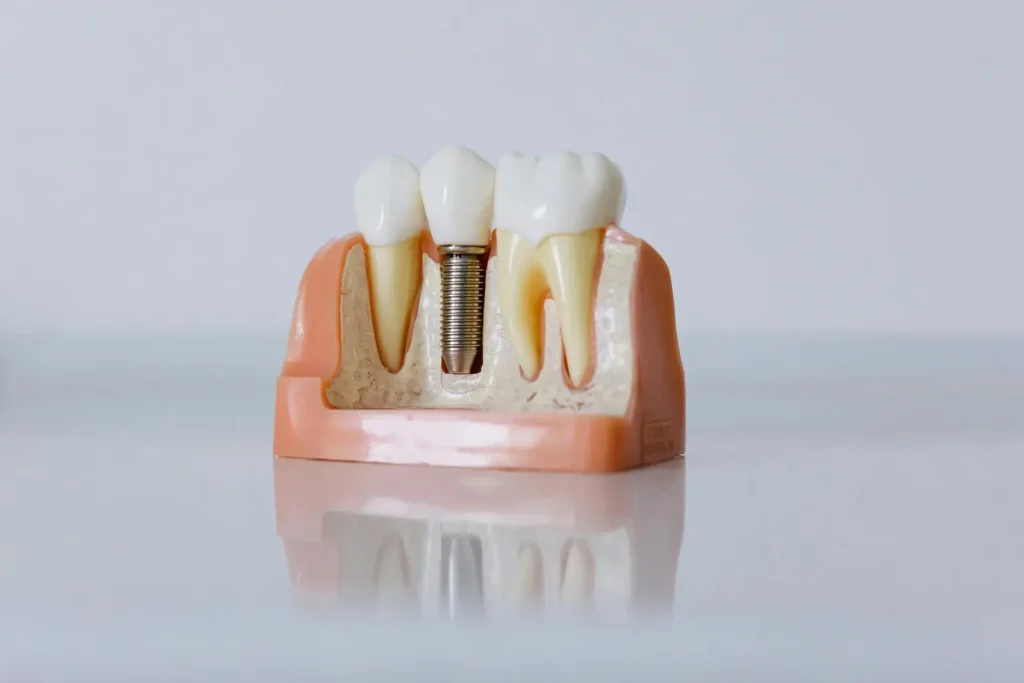 How to Care for Your Dental Implants