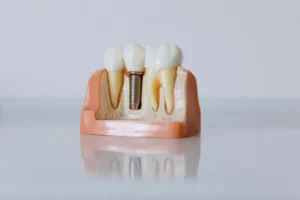 How to Care for Your Dental Implants