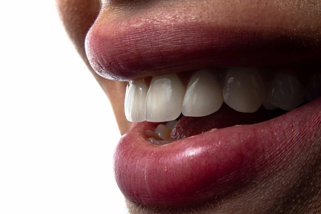 Fluoride Treatment - Emerald Peak Dental
