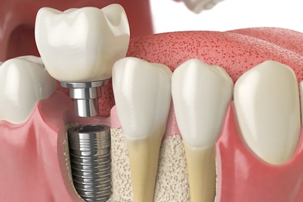 dental implant cost