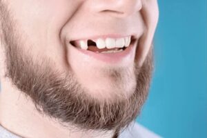 Knocked out tooth in Anchorage