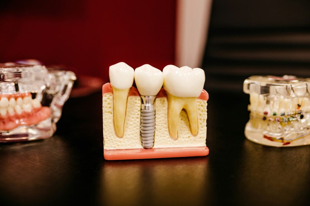 Upper Dental Implants Cost Explained | Anchorage Implant Treatment