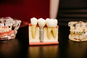 Upper Dental Implants Cost Explained | Anchorage Implant Treatment