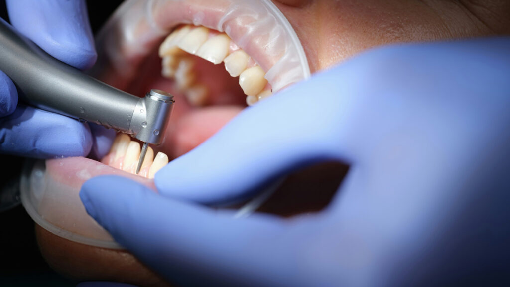 Anchorage Smile Makeover