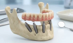 All-on-4 dental implant model showing a full arch restoration on a lower jawbone