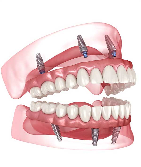 All-on-4 or Implant Prosthetics in Anchorage
