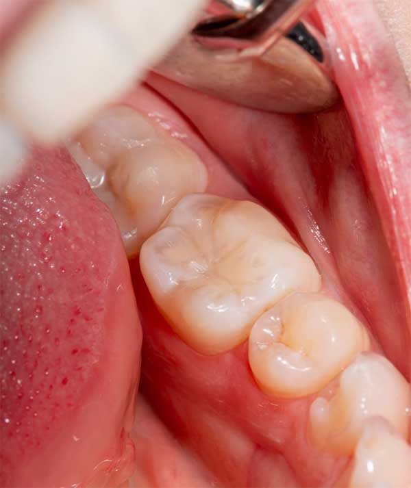 Composite Fillings in Anchorage