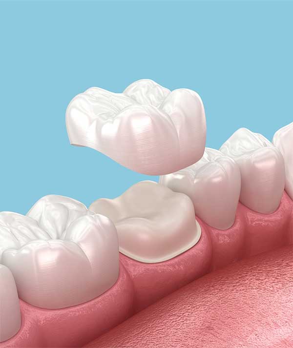 Crowns & Bridges in Anchorage