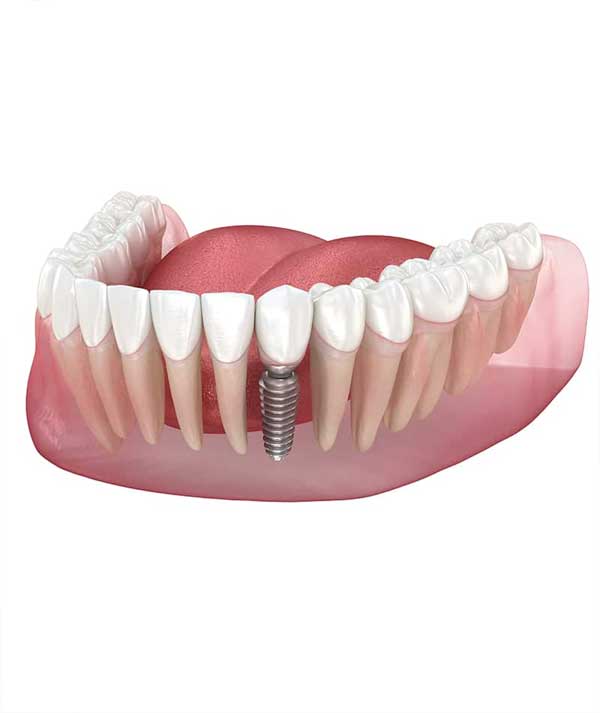 Dental Implants in Anchorage