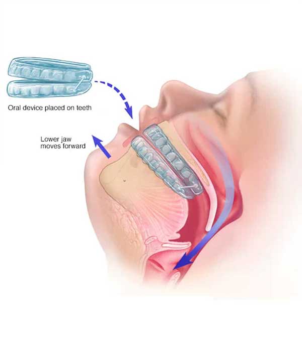 Sleep Apnea Treatment in Anchorage