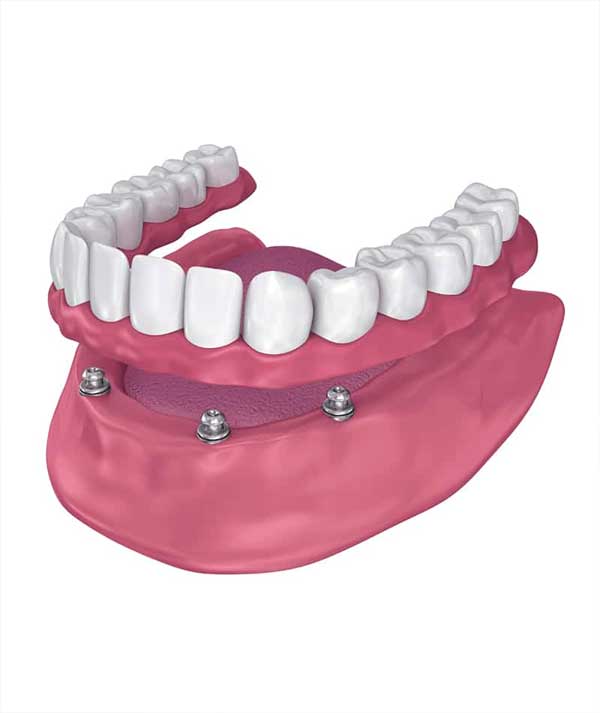Snap-in Dentures in Anchorage