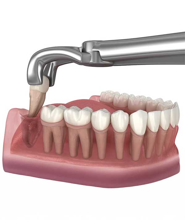 Tooth Extraction in Anchorage