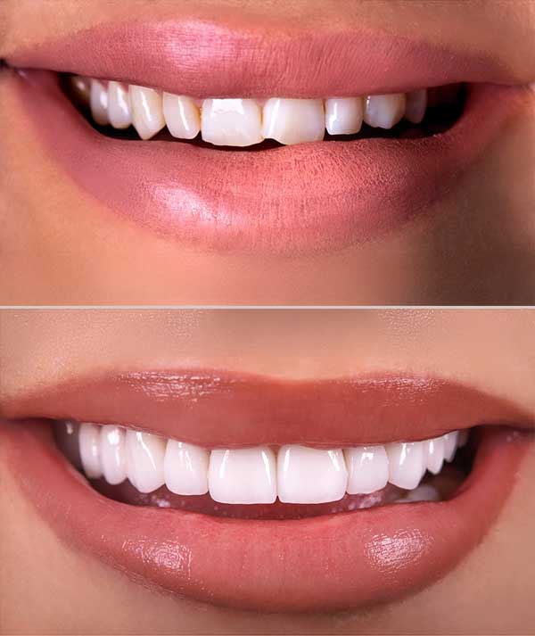Veneers in Anchorage
