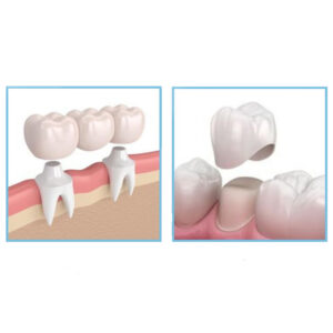 affordable crowns and bridges in Anchorage