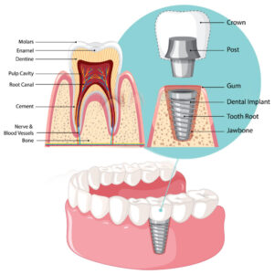 snap in dental implants