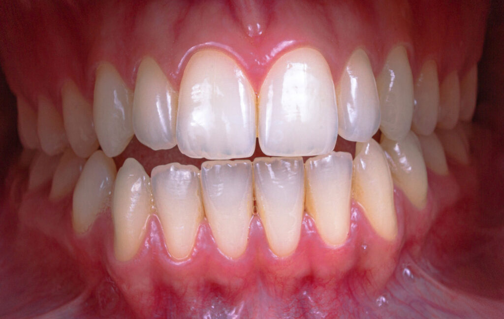 Wisdom Teeth Removal in Anchorage