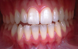Wisdom Teeth Removal in Anchorage