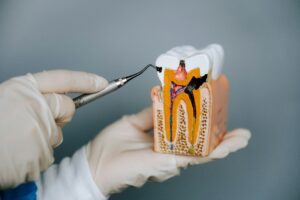 root canal Anchorage